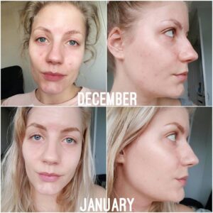 Ordinary Niacinamide Serum Result