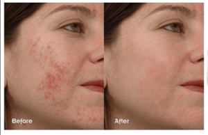 The Ordinary Niacinamide result