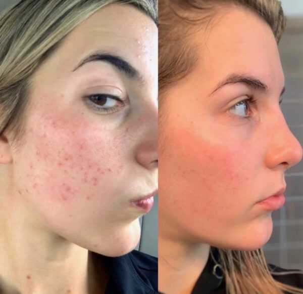 The Ordinary Retinol 0.2% In Squalane - Image 5